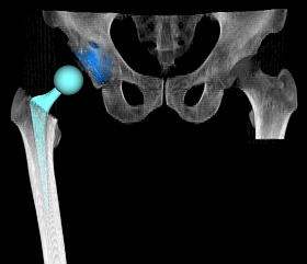 ステムに接続する骨頭のオフセットを調整する図